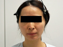 【他院術後】36歳女性　3回めの頬アゴ脂肪吸引は・・・（VASER）