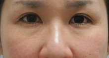 40歳女性　　経結膜脱脂術+眼窩脂肪注入でクマ改善
