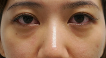 25歳女性　若いのに目の下のクマ(　･(ｪ)･) 　経結膜脱脂術+眼窩脂肪注入