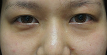 女性は3度美しくなる（●｀・ω・´●）　【埋没→経結膜脱脂術+眼窩脂肪注入→涙袋】