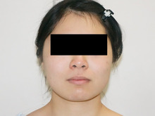 22歳女性　146cm40kg　頬アゴ下ベイザー+ほうれい線・オトガイ脂肪注入