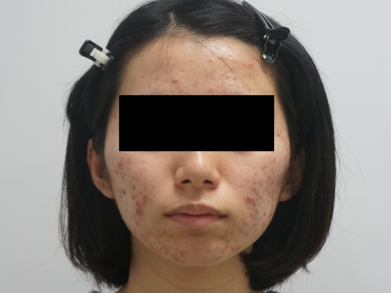 22歳　ロアキュタン（アキュテイン）で大人ニキビ治療