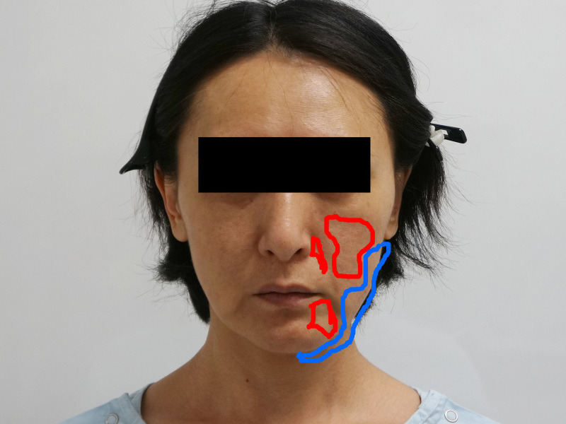 【1年後】48歳女性の切るフェイスリフト（脂肪吸引・脂肪注入併用）