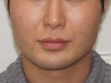 29歳男性　エラボツリヌストキシンでスッキリ小顔