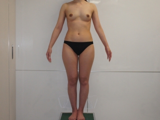 ☆48　30歳女性　157cm49kg　大腿臀部膝周りVASER+CRFバスト