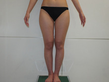 ☆48　30歳女性　157cm49kg　大腿臀部膝周りVASER+CRFバスト2　下半身