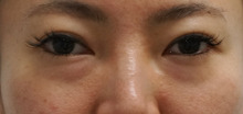 38歳女性　目の下のクマ（経結膜脱脂術+脂肪注入）涙袋が出現！！