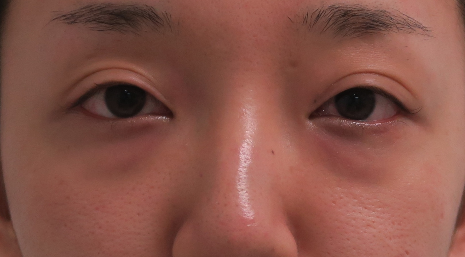 27歳女性　目の下のクマ　経結膜脱脂術+眼窩脂肪注入　（術後眼瞼浮腫）