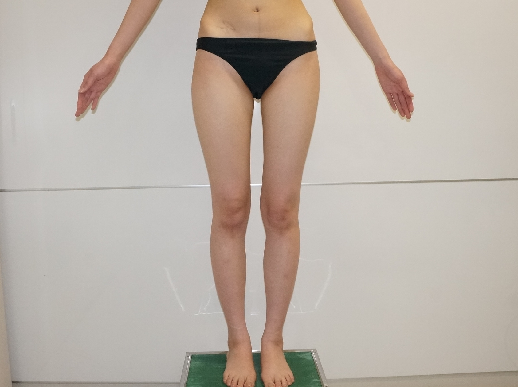 ☆49　23歳女性　極痩せ・バスト無し→実感できるバスト　VASER+CRF豊胸　2