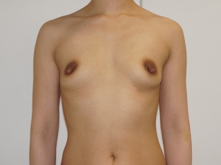☆50　35歳女性（153cm46kg）　大腿臀部膝周りベイザー脂肪吸引+CRFバスト　2