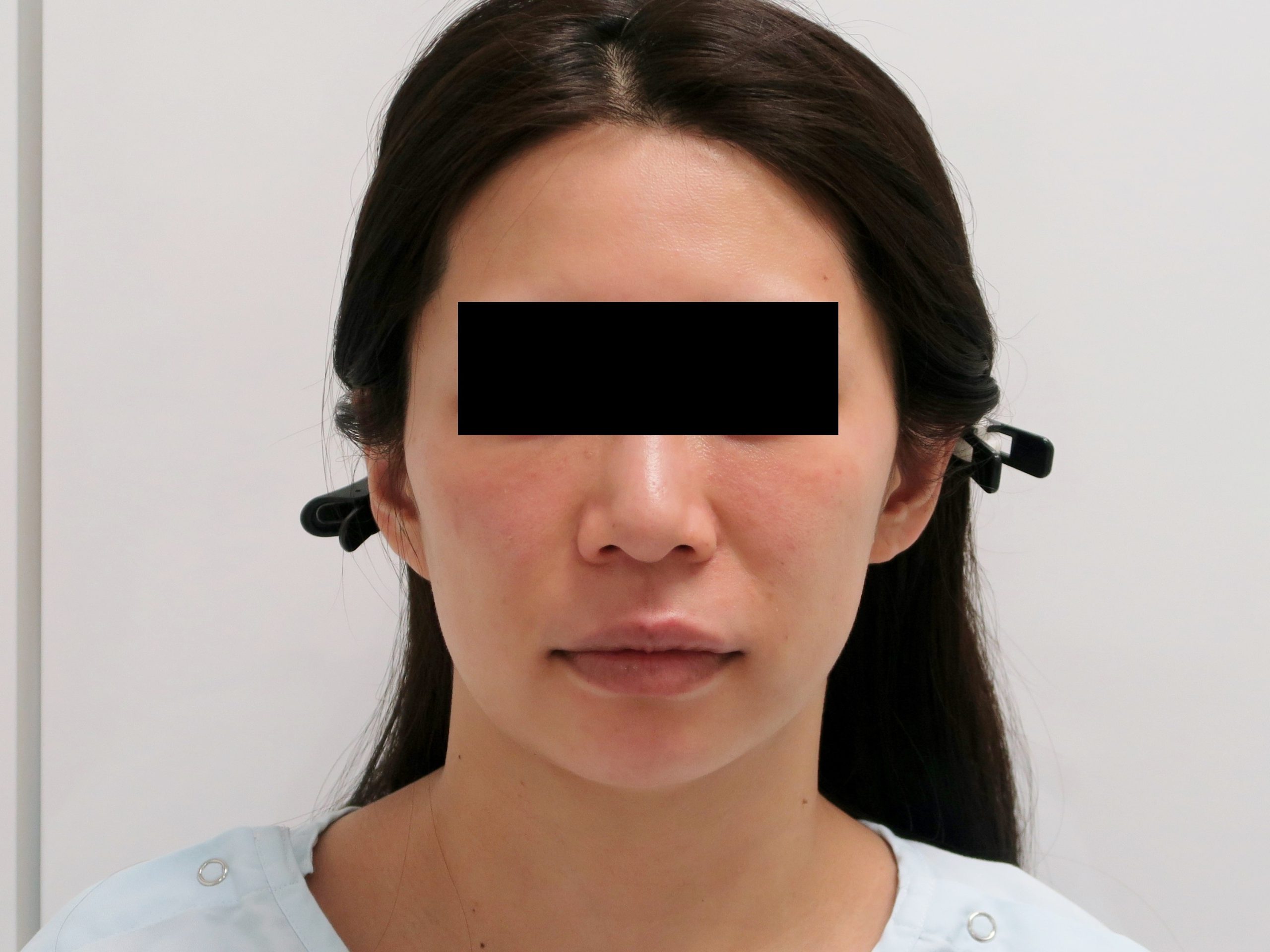 35歳女性　頬・アゴ下ベイザー脂肪吸引+中顔面・ほうれい線・マリオネット脂肪注入