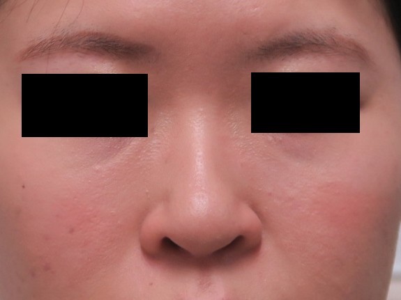 鼻のクレヴィエル　1cc全量使用で鼻根にも　“鼻がある”　と実感