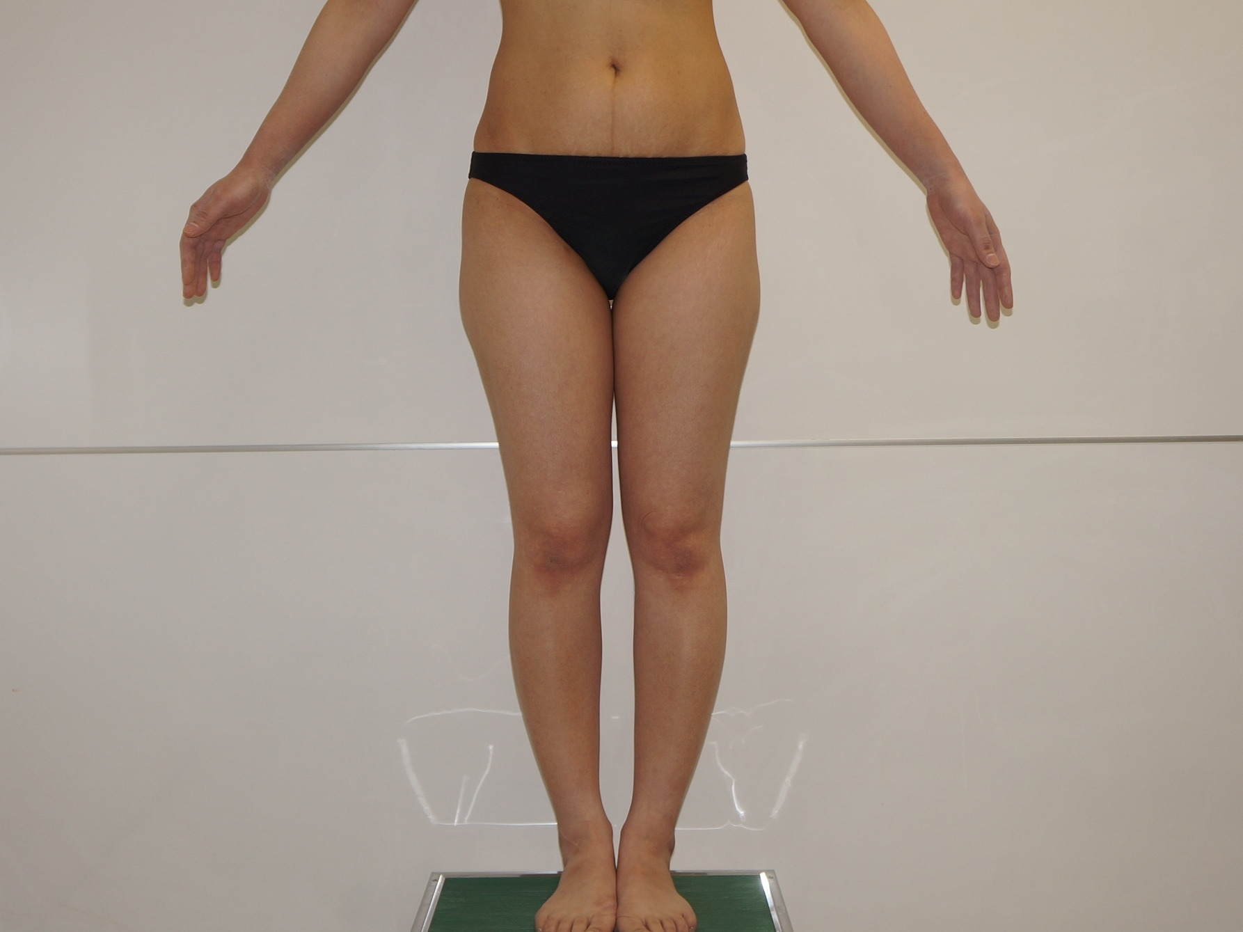 35歳女性（153cm46kg）　大腿臀部膝周りベイザー脂肪吸引+CRFバスト