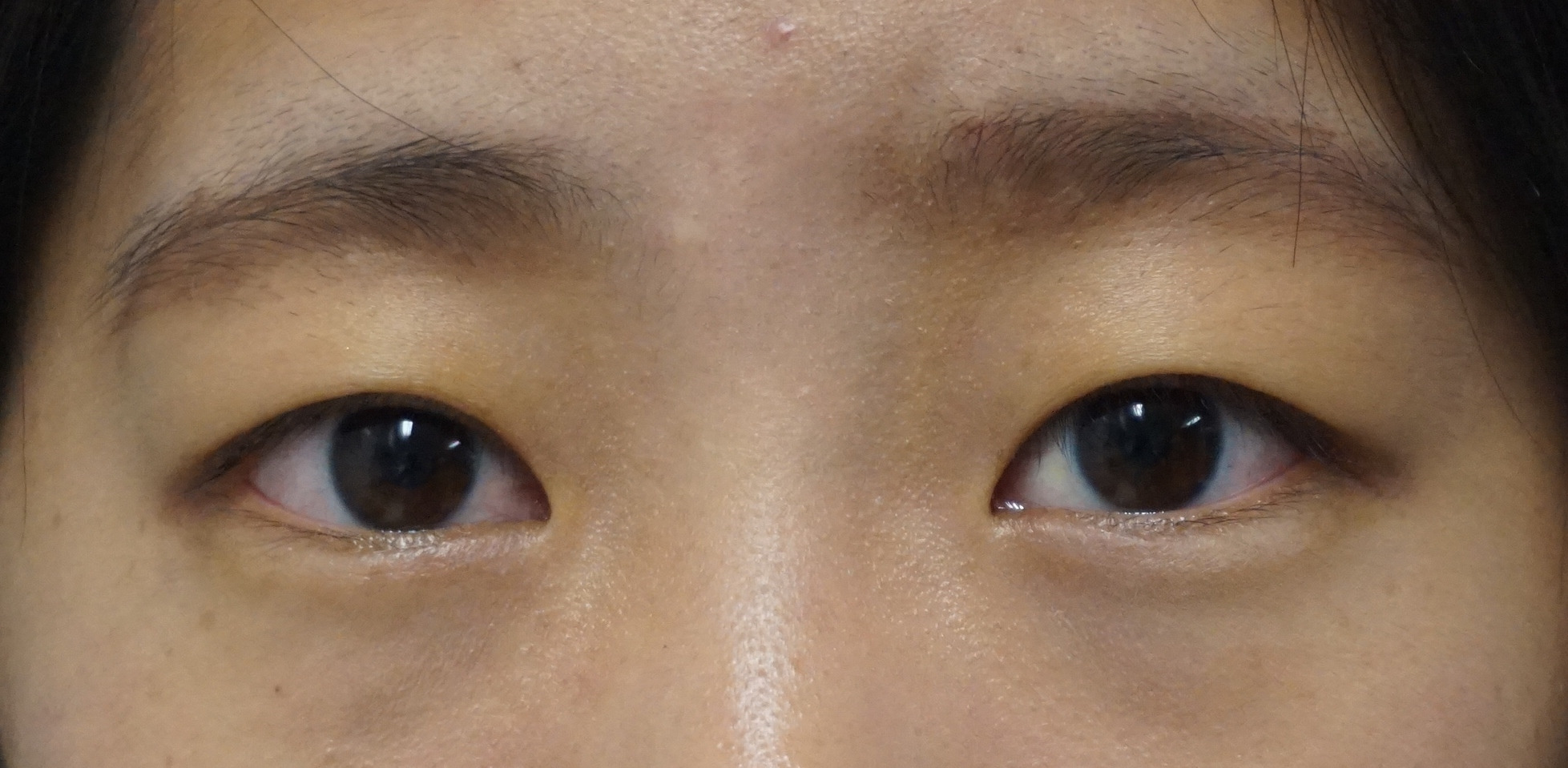 眉毛を挙げないと視界を確保できない奥二重→自然な末広型【セミプレミアムクイック】