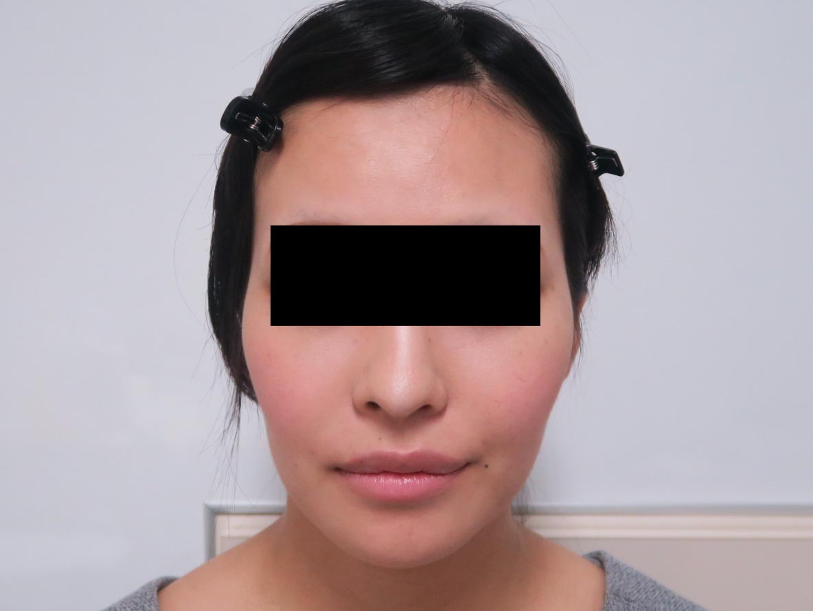 こめかみと頬のコケた感じの部分に10ccのヒアルロン酸