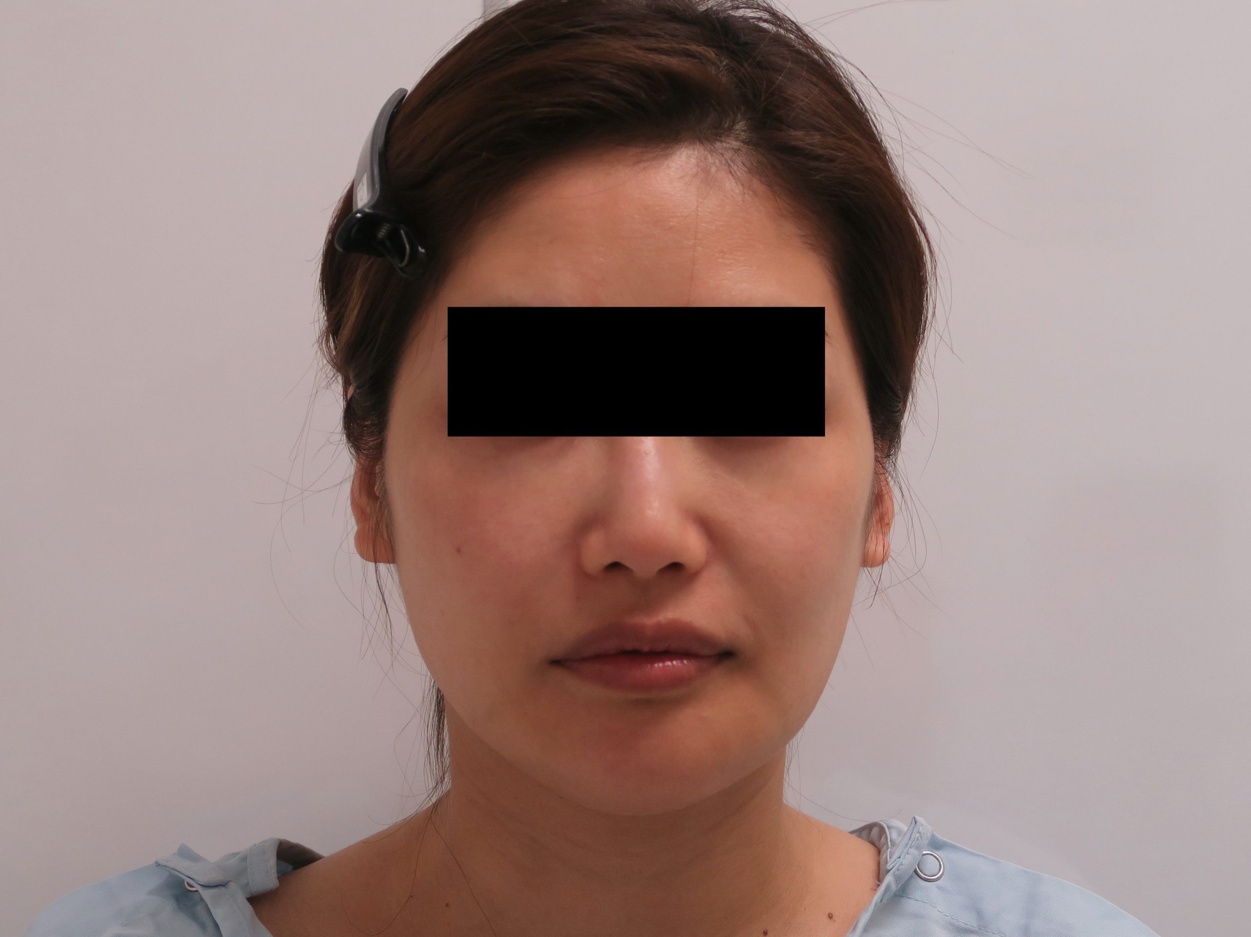 41歳女性　オトガイ削り後　頬アゴ下ベイザー+中顔面・ほうれい線・マリオネットライン脂注
