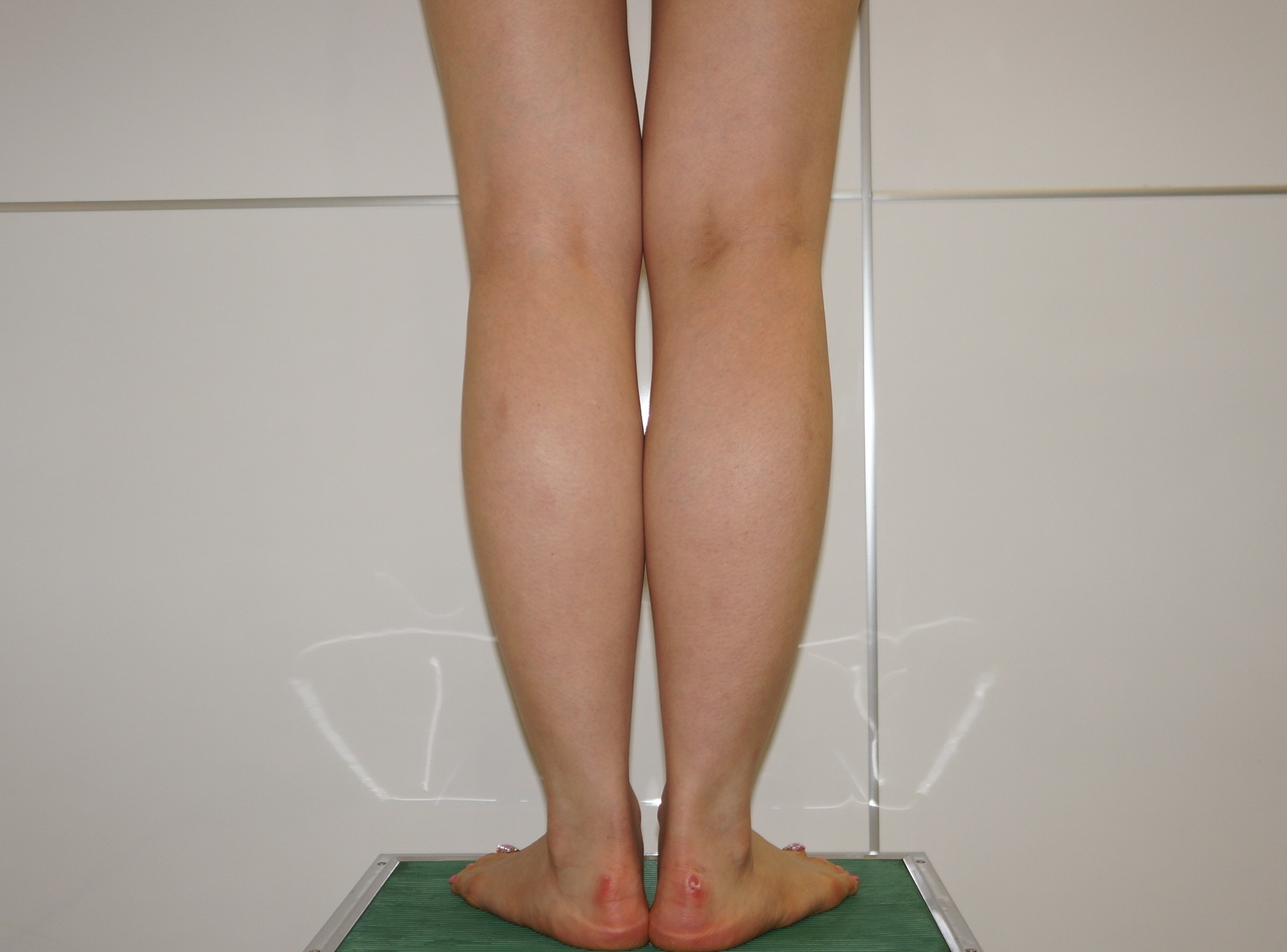 35歳女性163cm53kg　下腿（ふくらはぎ）足首VASER　脂肪吸引
