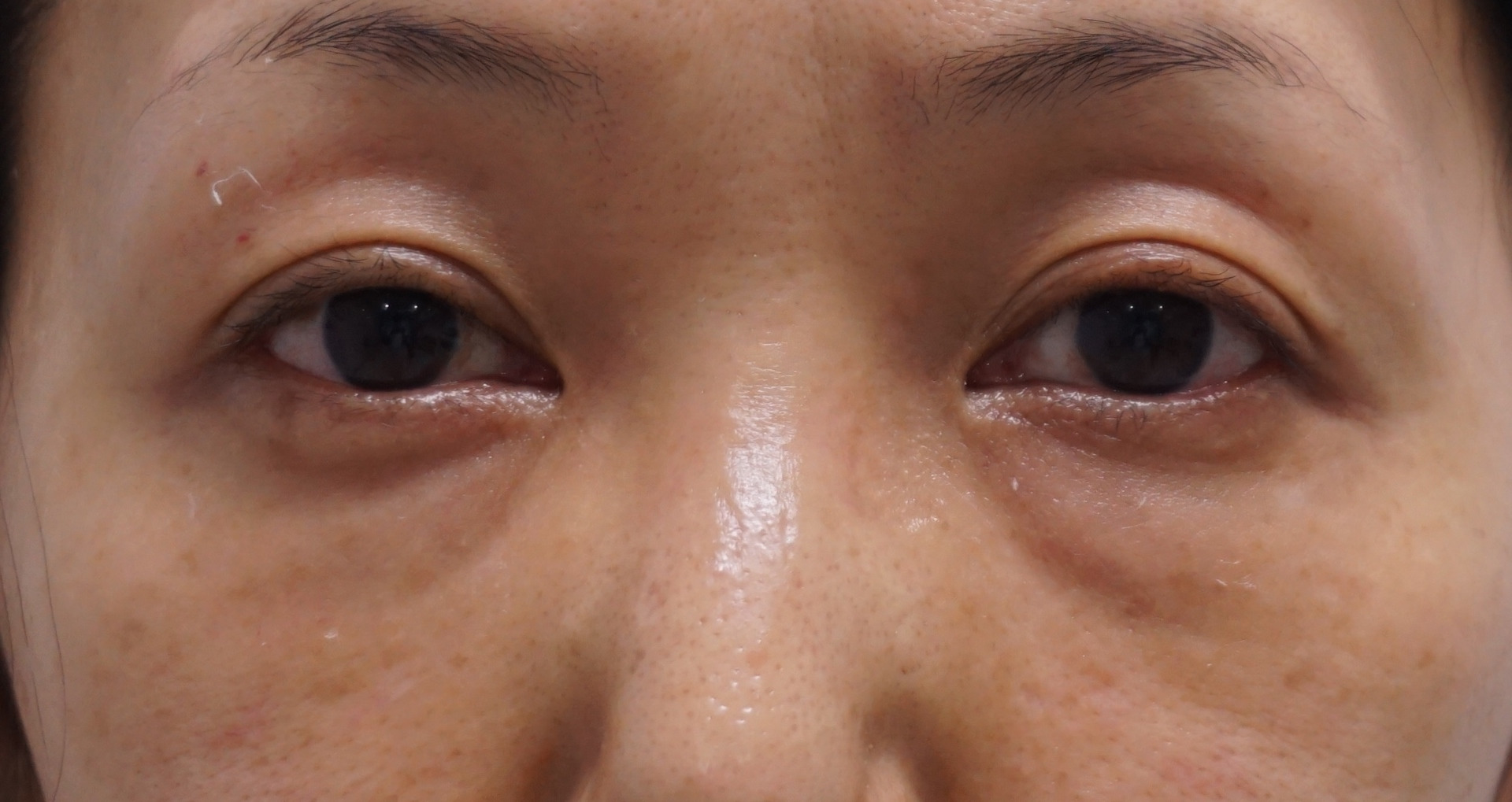 51歳女性　目の下のクマを切らない手術で大改善　（経結膜脱脂術+眼窩脂肪注入）