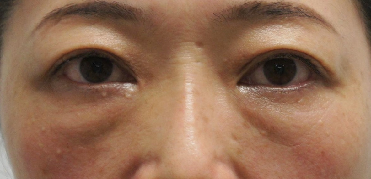 【術後4年】経結膜脱脂術+眼窩脂肪注入　45歳→49歳