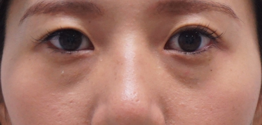 32歳女性　経結膜脱脂術+眼窩脂肪注入　　右セミプレミアムクイックとともに