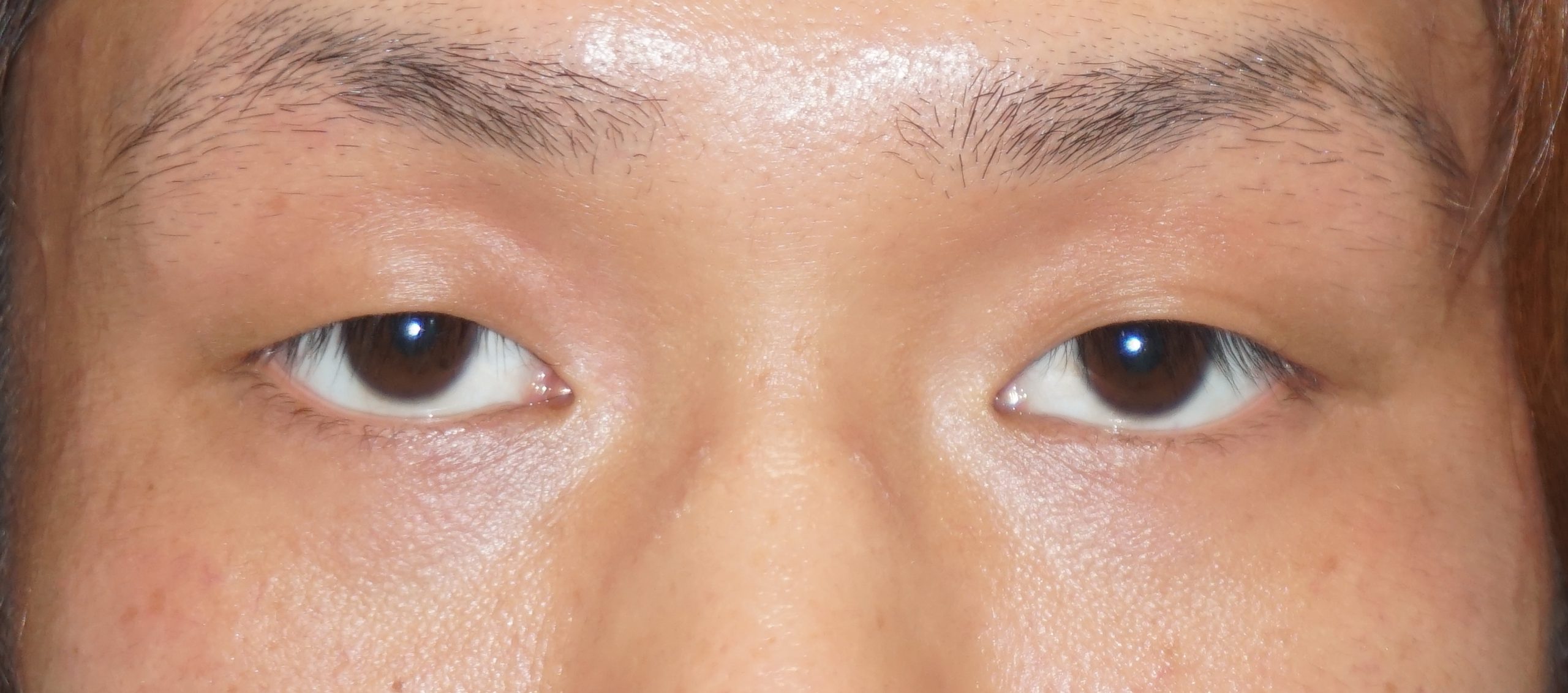 一重男性プレミアムクイック　自然な末広型の二重へ