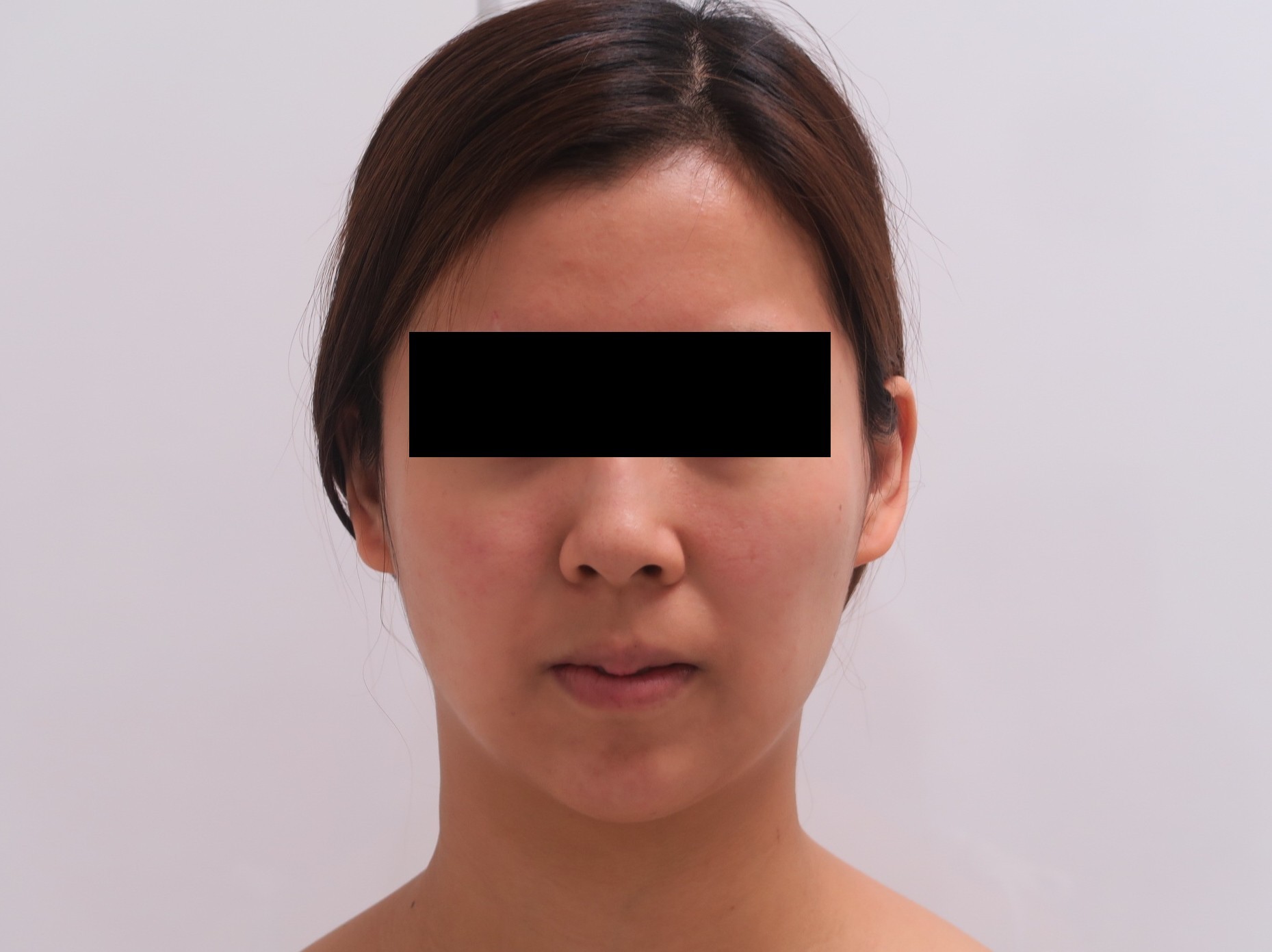 24歳女性　頬アゴ下ベイザー+中顔面脂肪注入で立体感のある美人顔に(9￣^￣)9ﾑｷｯ