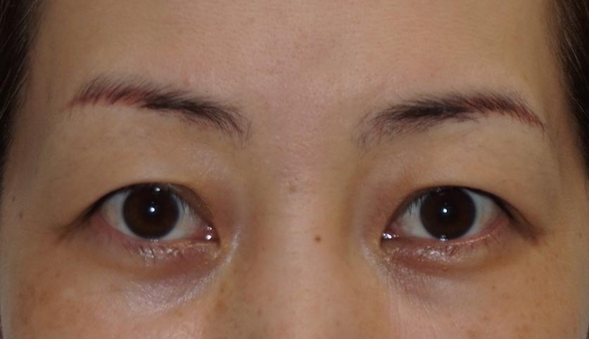 ☆4　44歳女性　眉下切開による上瞼のたるみ取り