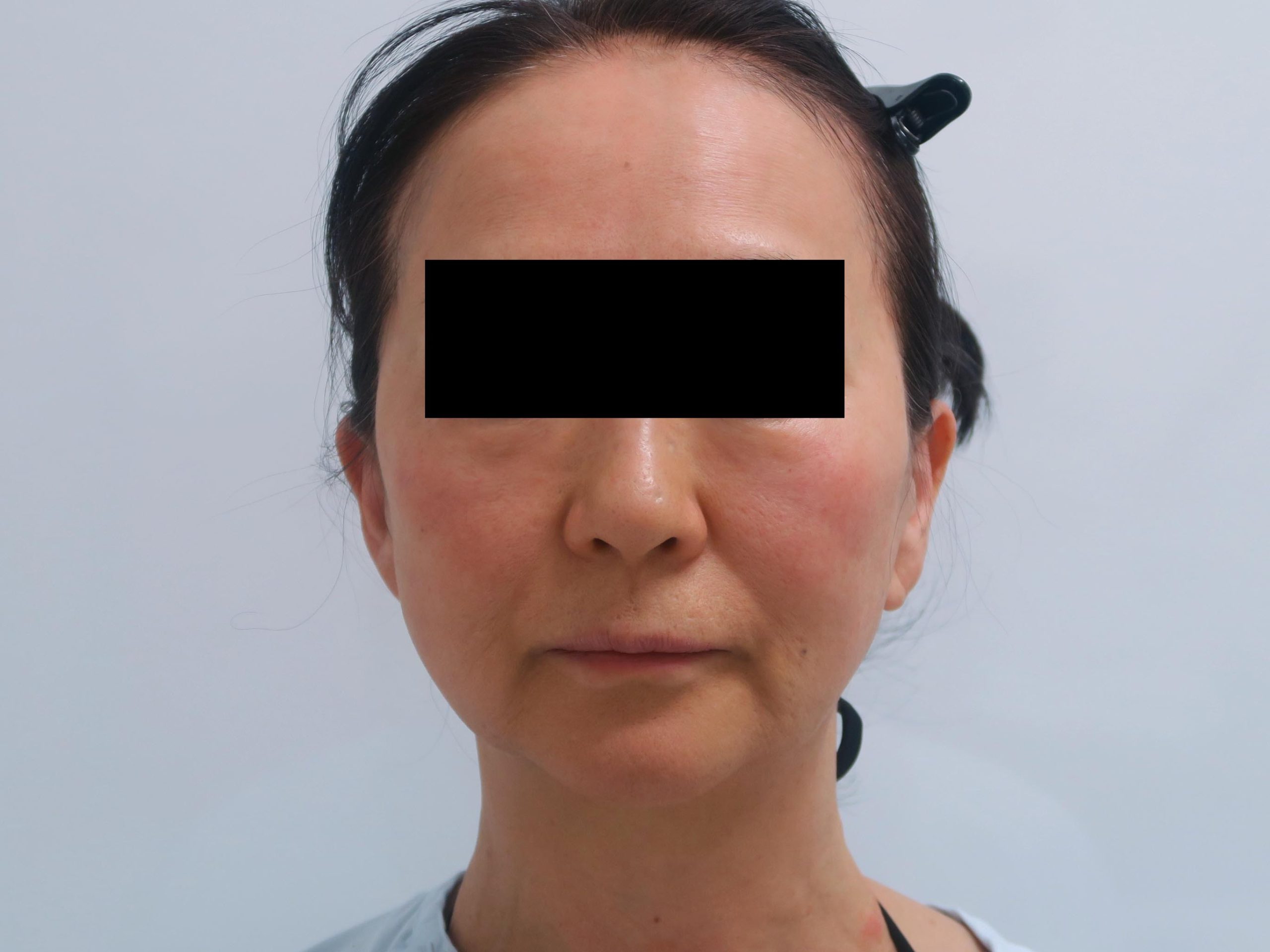 【術後半年】61歳女性　シグネチャーリフト+頬アゴ下ベイザー+中顔面・オトガイ・ほうれい線脂注