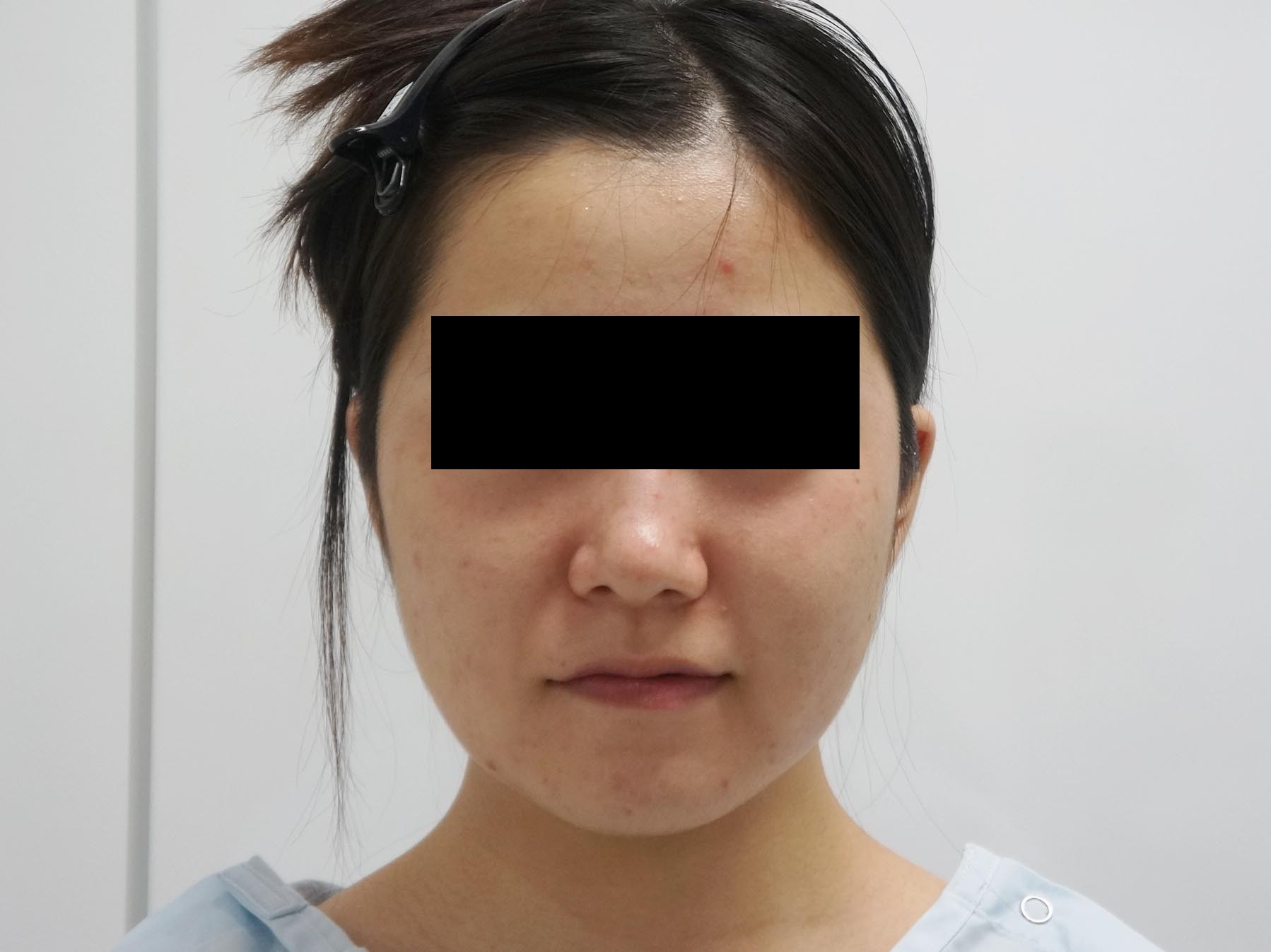 24歳女性　頬アゴ下ベイザー脂肪吸引　大人っぽい顔つきへ(*^^*)