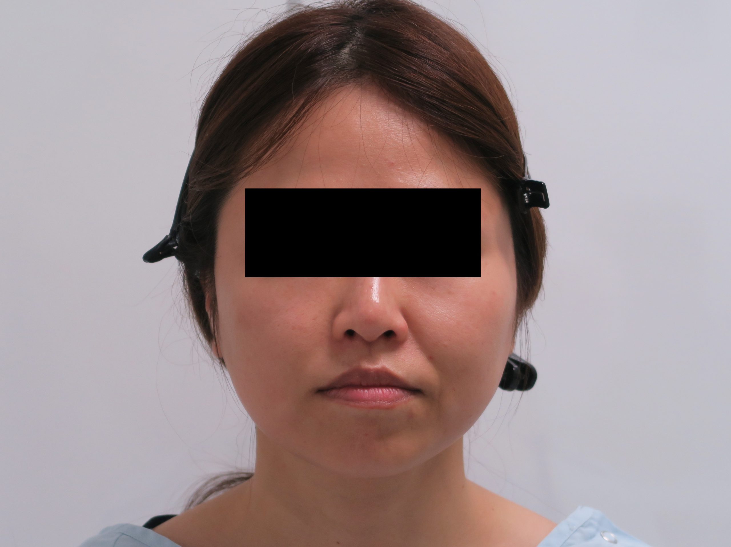 【別人級】38歳女性　頬アゴ下ベイザー脂肪吸引+ほうれい線・中顔面脂肪注入