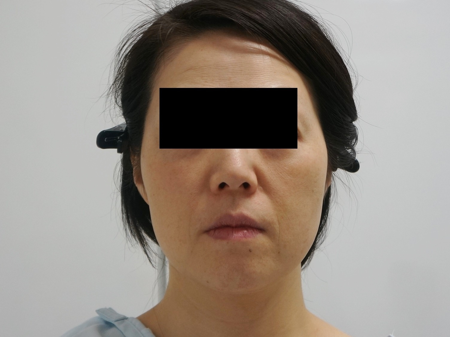 フェイスリフト？ミントリフト？　いえ、VASER頬アゴ脂肪吸引+脂肪注入です（●｀・ω・´●）2