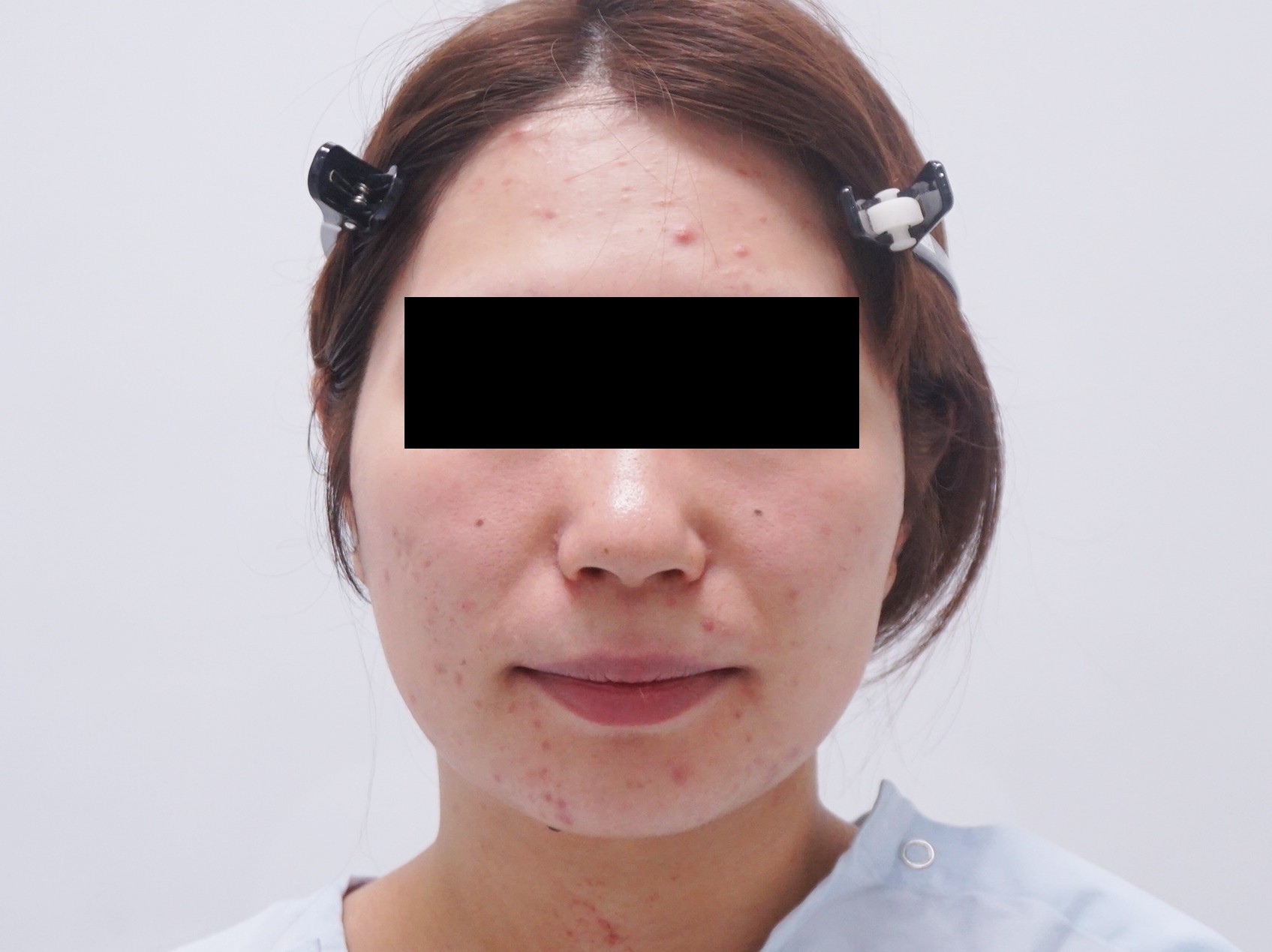 【別人級】28歳女性　頬アゴ下ベイザー脂肪吸引+エラボツリヌストキシン
