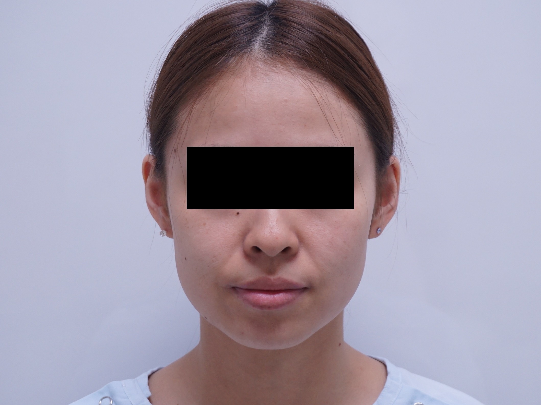 24歳女性　頬アゴ下ベイザー脂肪吸引+ほうれい線脂肪注入で　“美顔”！！