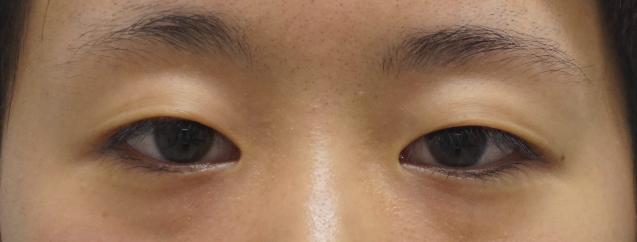 一重+眼瞼下垂あり　プレミアムクイックでまずは末広型の二重