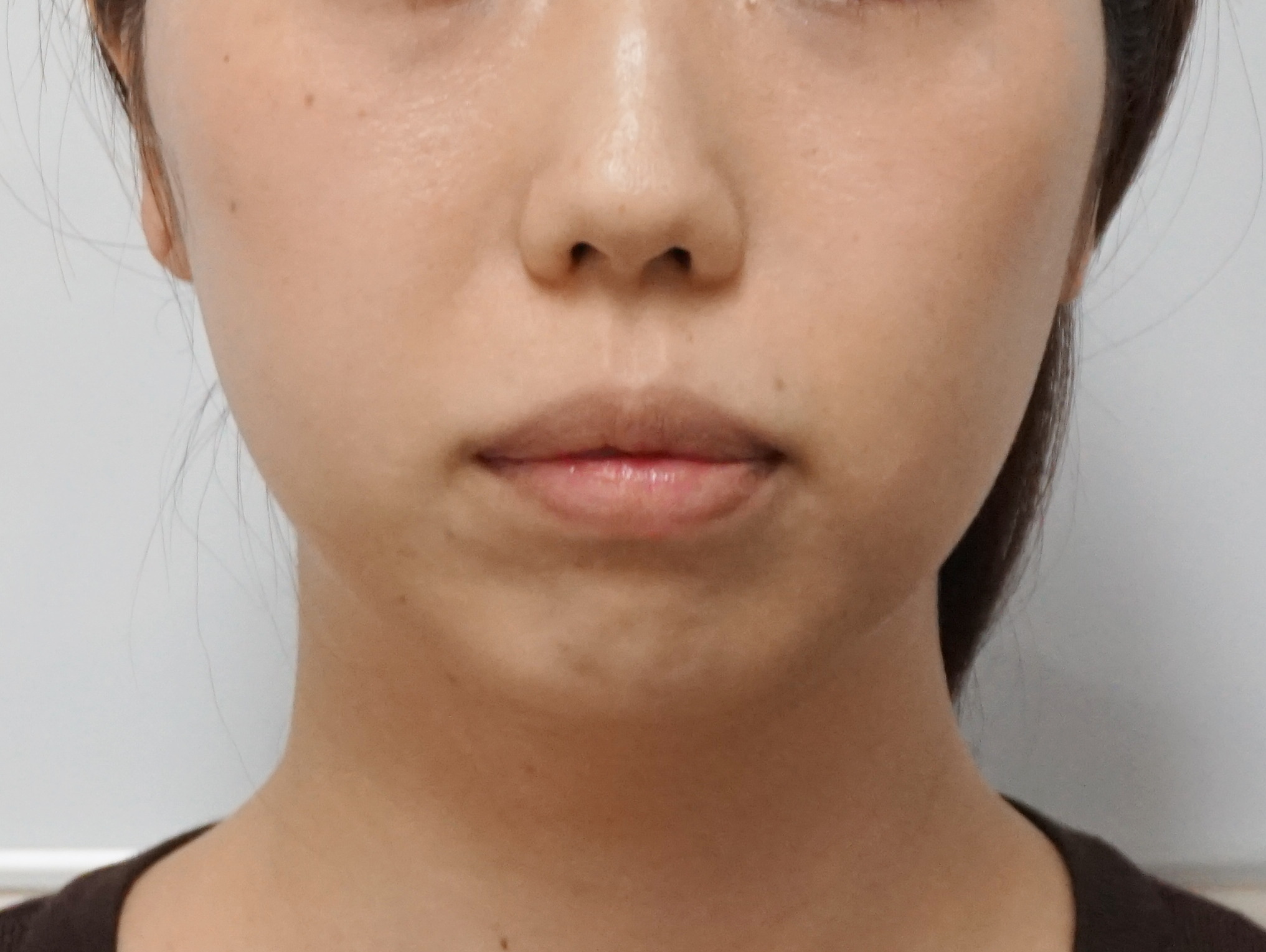 【軽いストレートネック】アゴのクレヴィエル2ccでスッキリとした印象へ