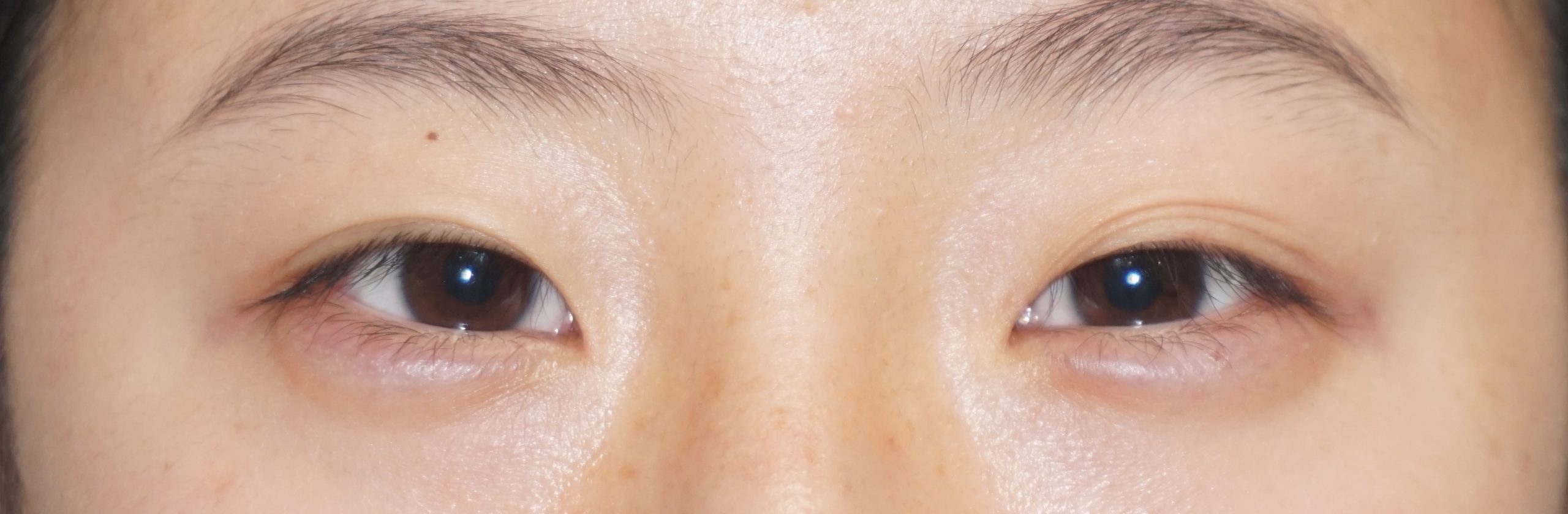 眼瞼下垂ありの末広型から無理のない範囲の準平行型