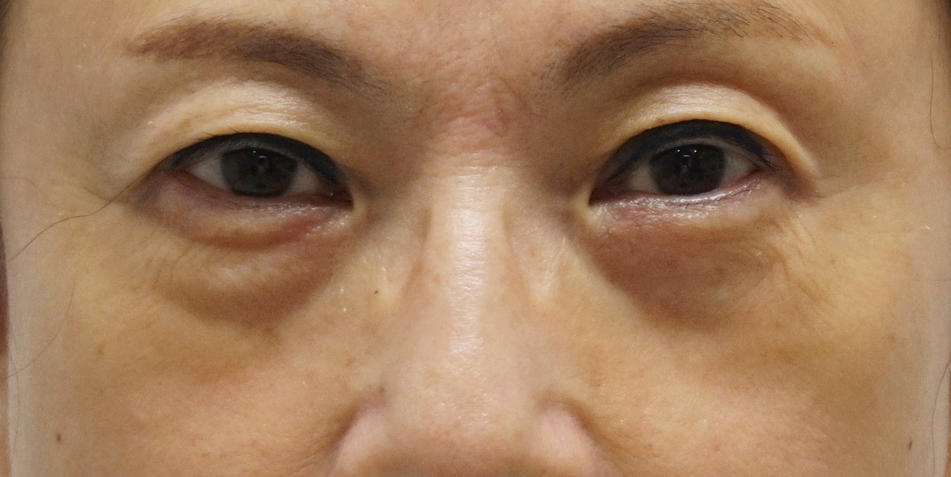 53歳女性　目の下の見た目加齢（クマ）経結膜脱脂術+眼窩脂肪注入で改善
