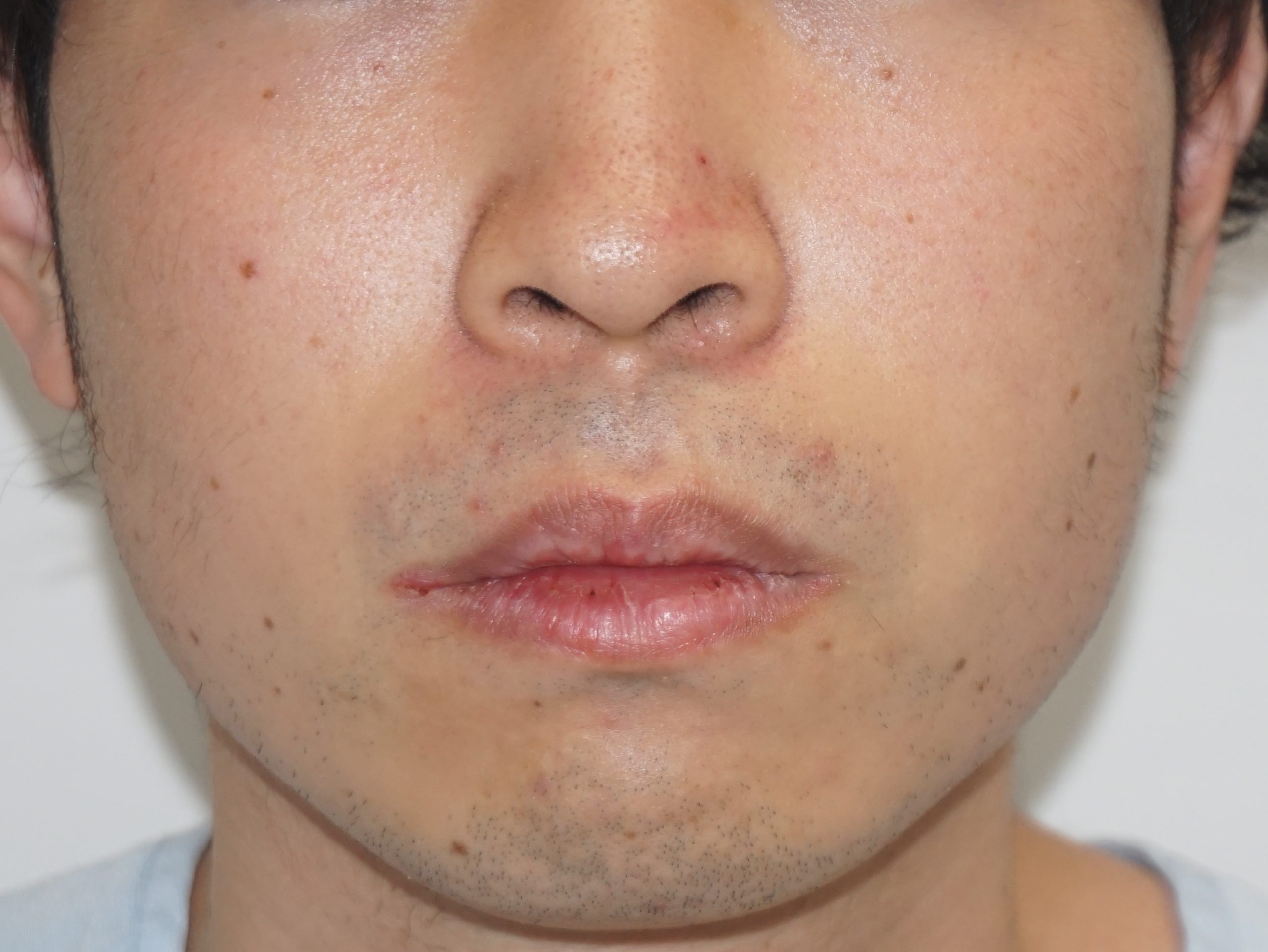 ★4　22歳男性　上下口唇縮小（唇を薄く）　　術後1ヶ月まで