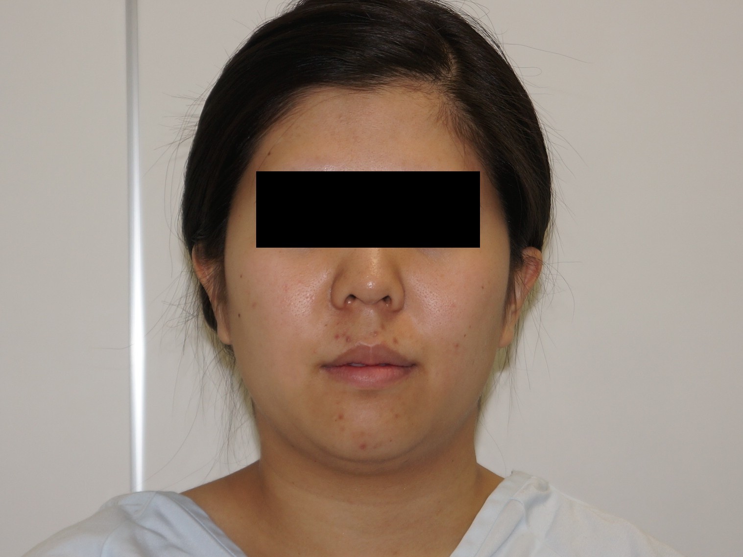 25歳163cm57kg　頬アゴ下ベイザー脂肪吸引+オトガイ脂注　二重あご大幅改善！！