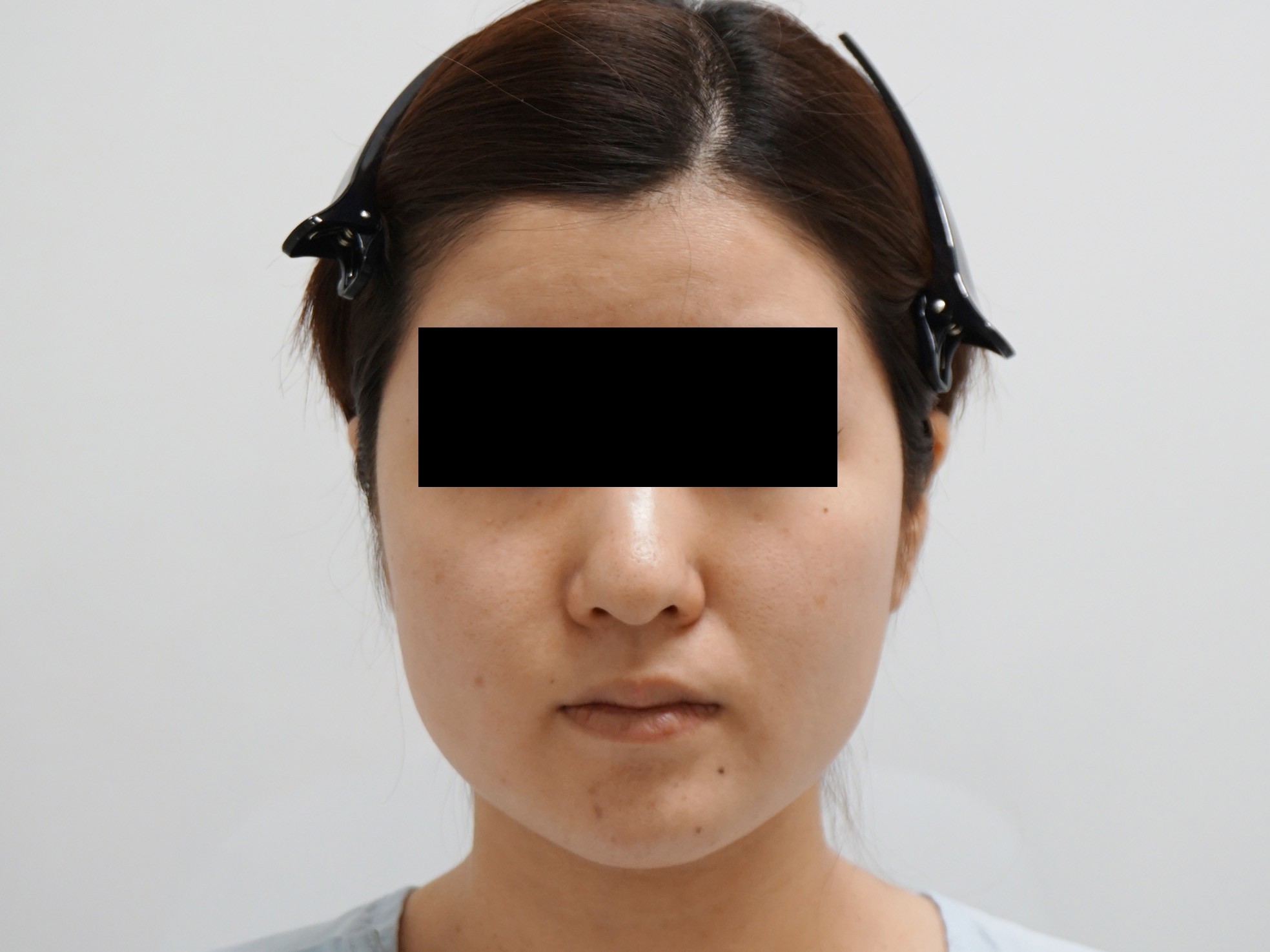 26歳女性158cm46kg　頬・アゴ下ベイザー脂肪吸引