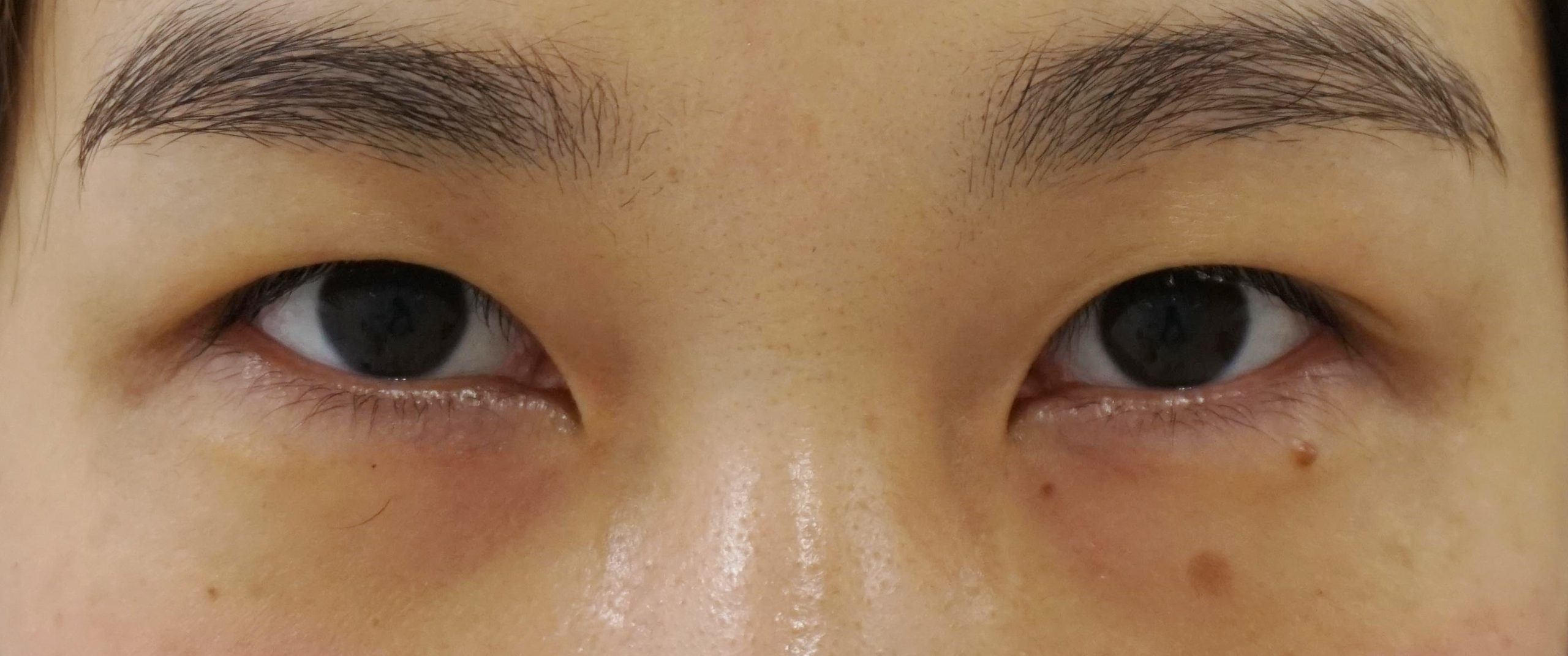 瞼の皮膚が厚い状態での奥二重→末広型　プレミアムクイック