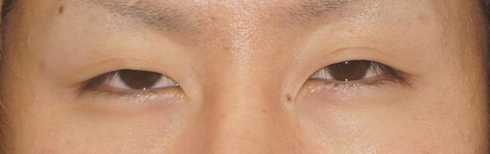 【男性 賛否両論】　強度及び中等度眼瞼下垂+一重→埋没法で平行型の二重