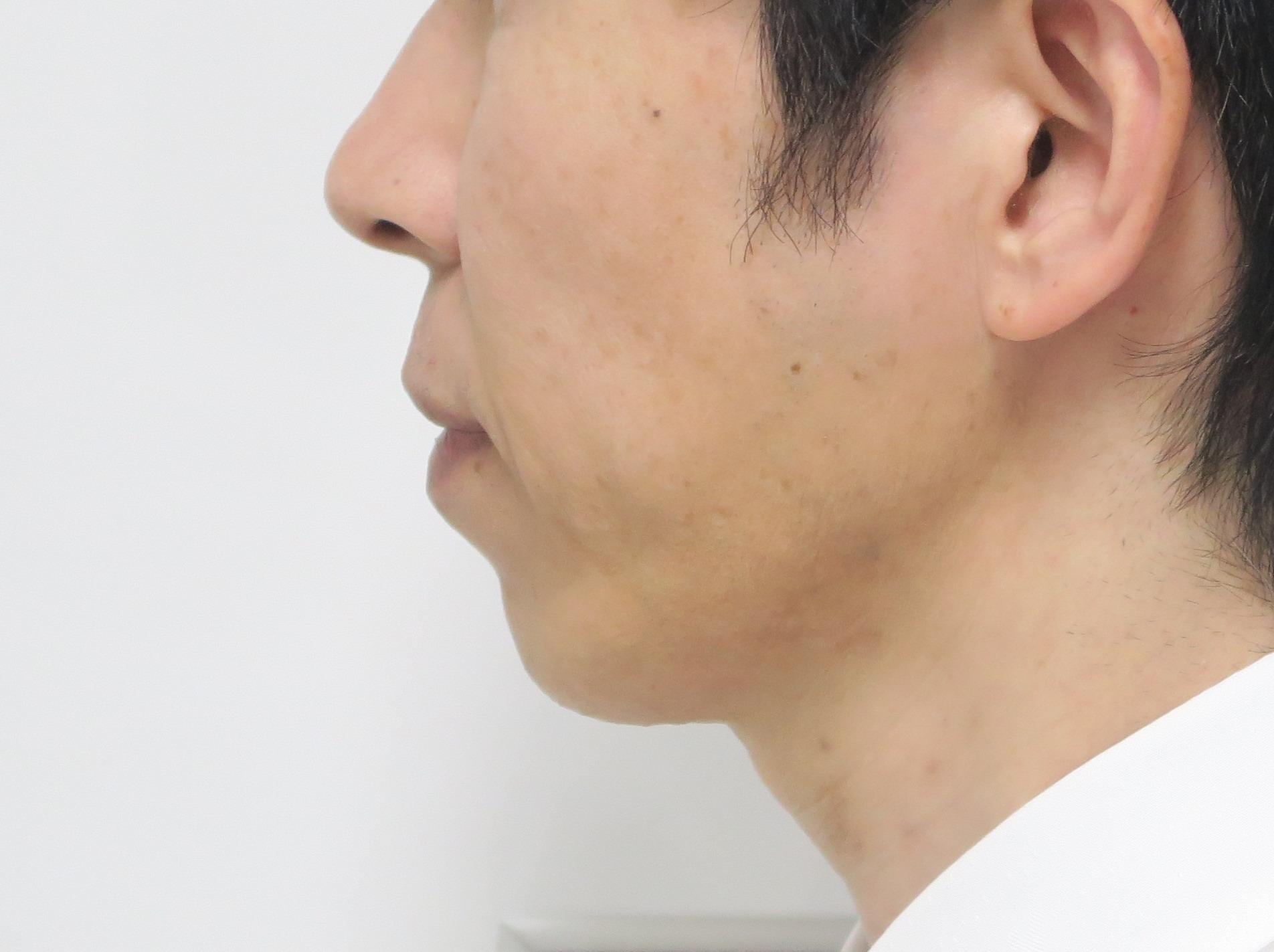 男もアゴのクレヴィエル2ccでeライン シンシア総院長ブログ Sincerely Yours 銀座の美容外科 美容皮膚科