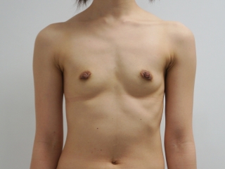 【術後1年】症例53　30歳女性　153cm47kg　ベイザー+CRF豊胸（バスト）