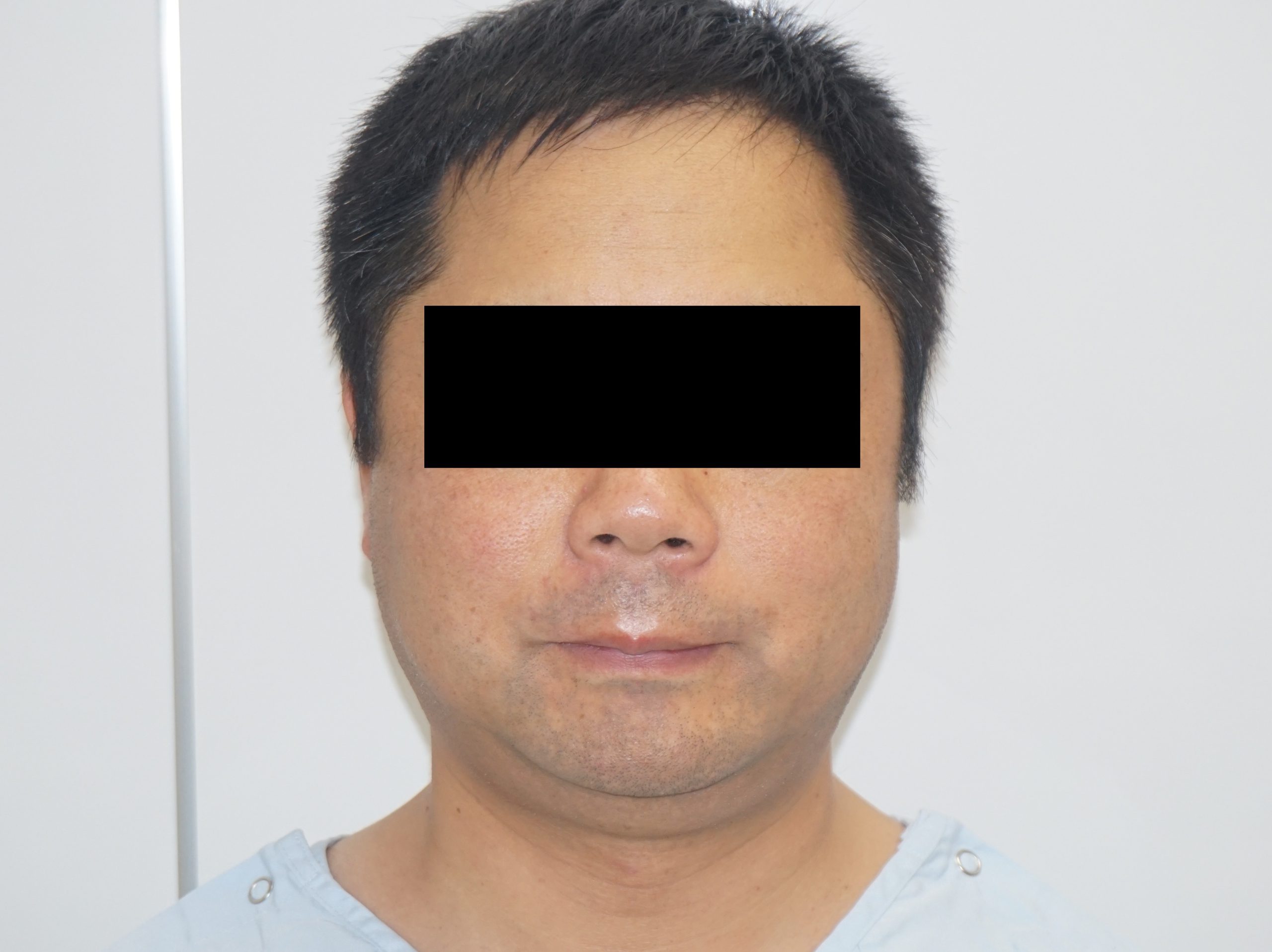 40歳男性　耳下腺と顎下腺の発達の強い場合の頬・アゴ下ベイザー脂肪吸引