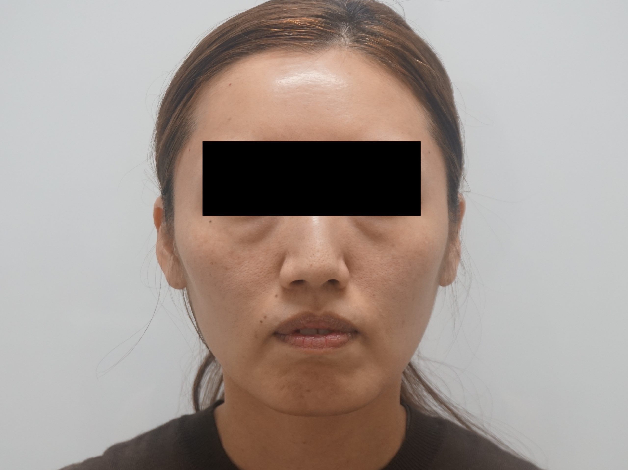 36歳の女性　10ccのヒアルロン酸でHappyな印象に(*^^*)