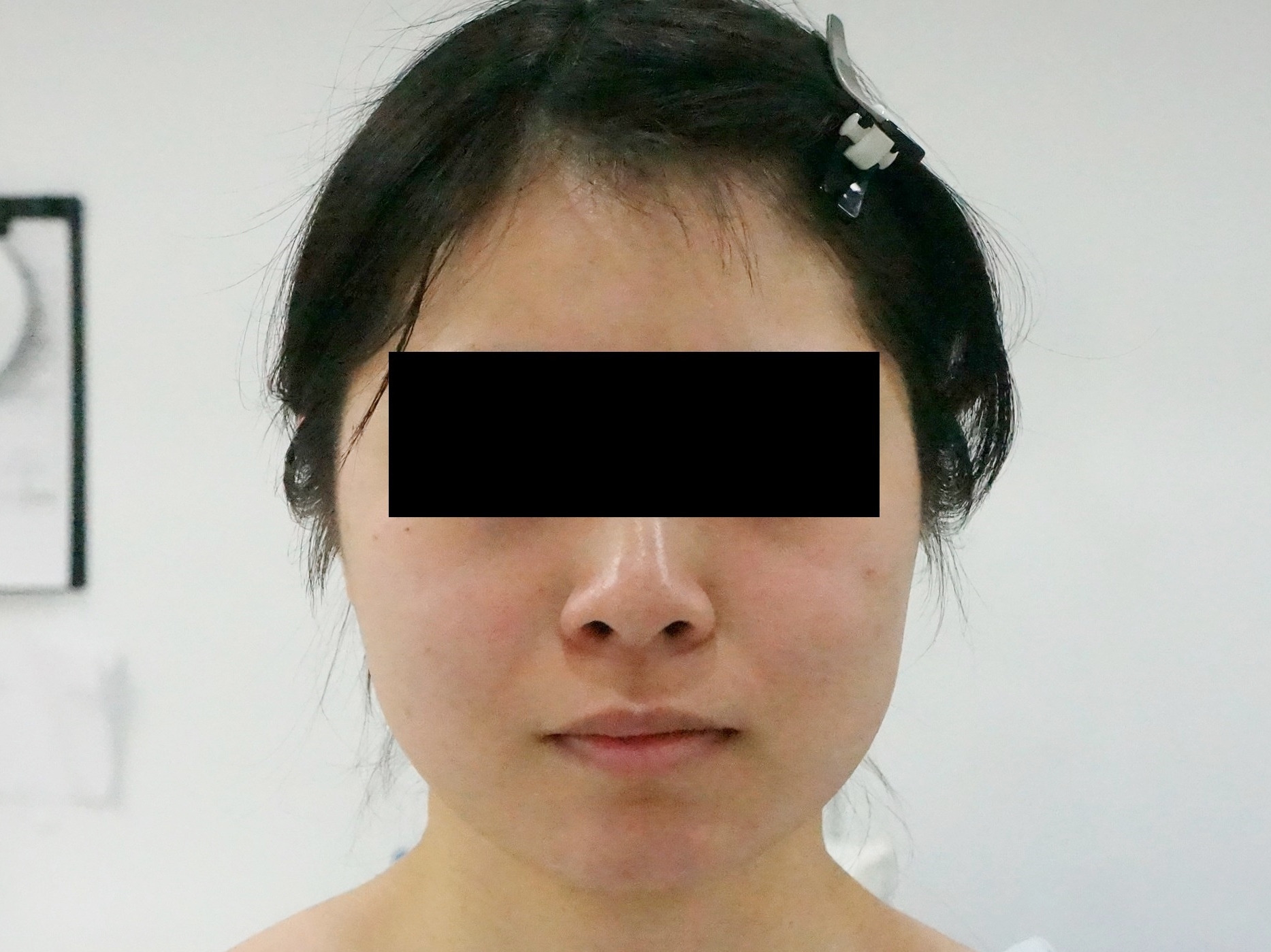 【術後1年】22歳女性　146cm40kg　頬アゴ下ベイザー+ほうれい線・オトガイ脂肪注入
