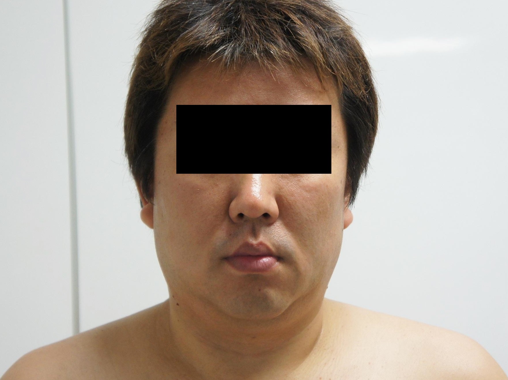 【4年後】46歳男性　頬・アゴ下ベイザー　術前より若く引き締まっている！！