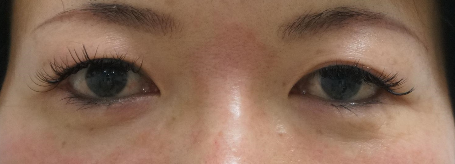 【術後8ヶ月】左目だけの眼瞼下垂あり　　埋没法→左目眼瞼下垂手術（腱膜固定術）