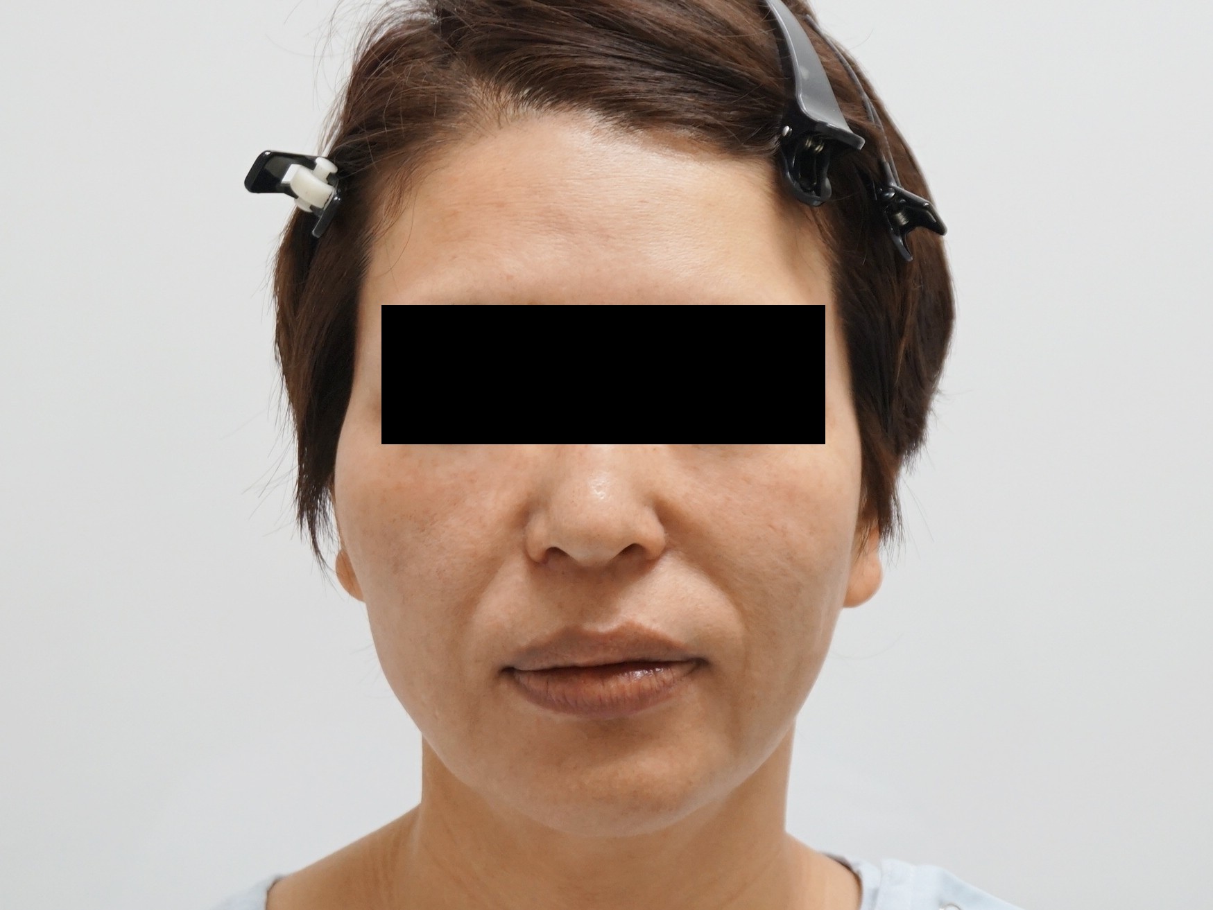 47歳女性　スプリングスレッドで強烈な引き上げ効果